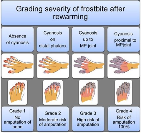 Frostbite grades.jpg